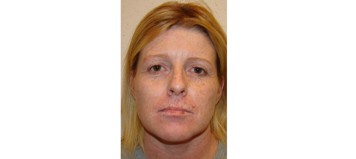 Before Treatment