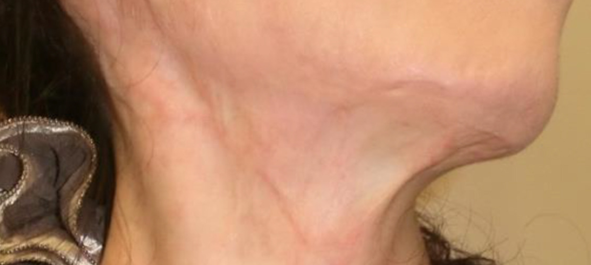 After Treatment