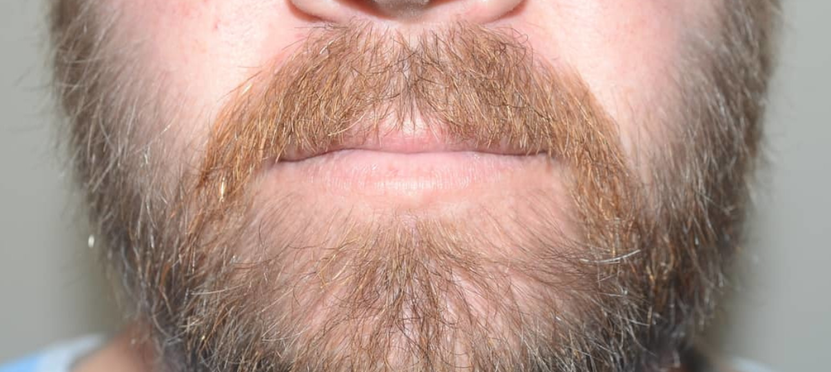 After Treatment