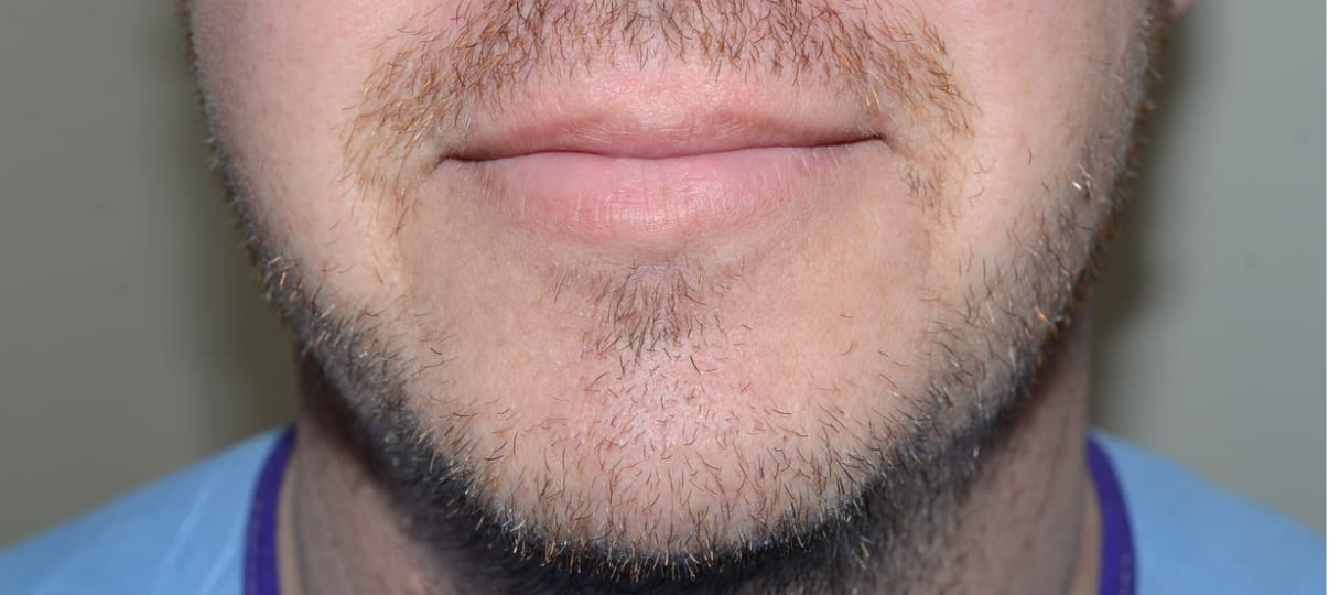 Before Treatment
