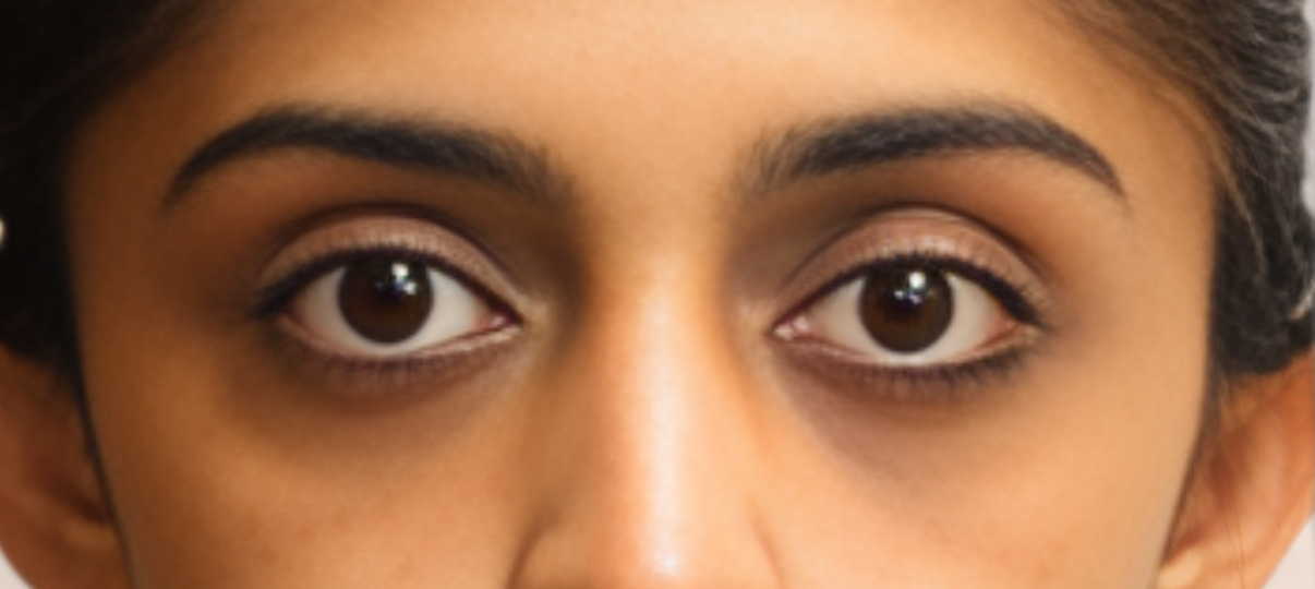 After Treatment