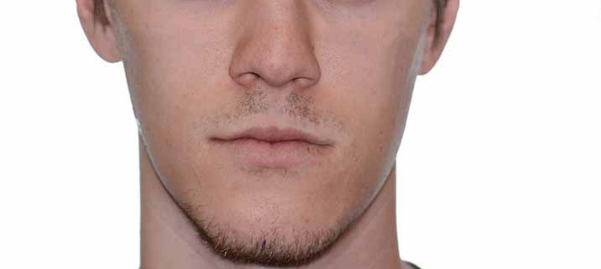 Before Treatment