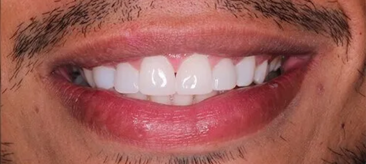 After Treatment