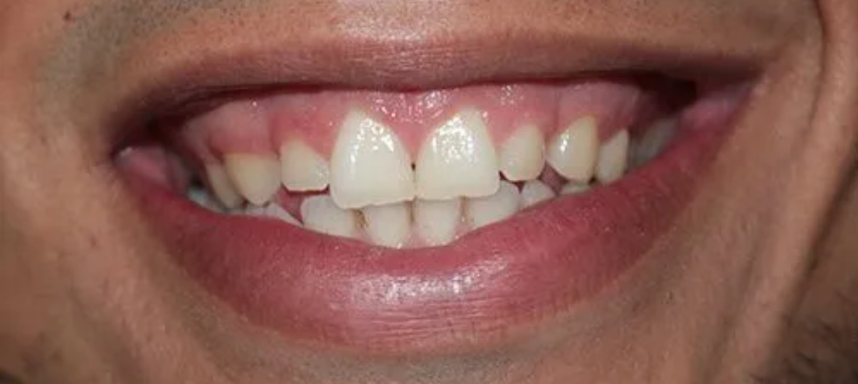 Before Treatment