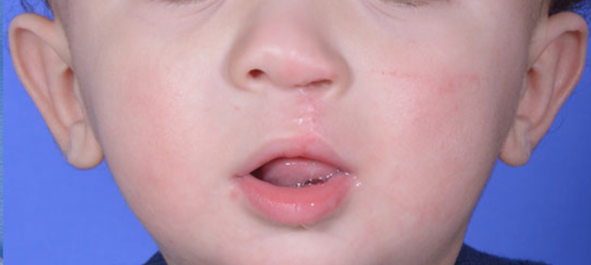 After Treatment