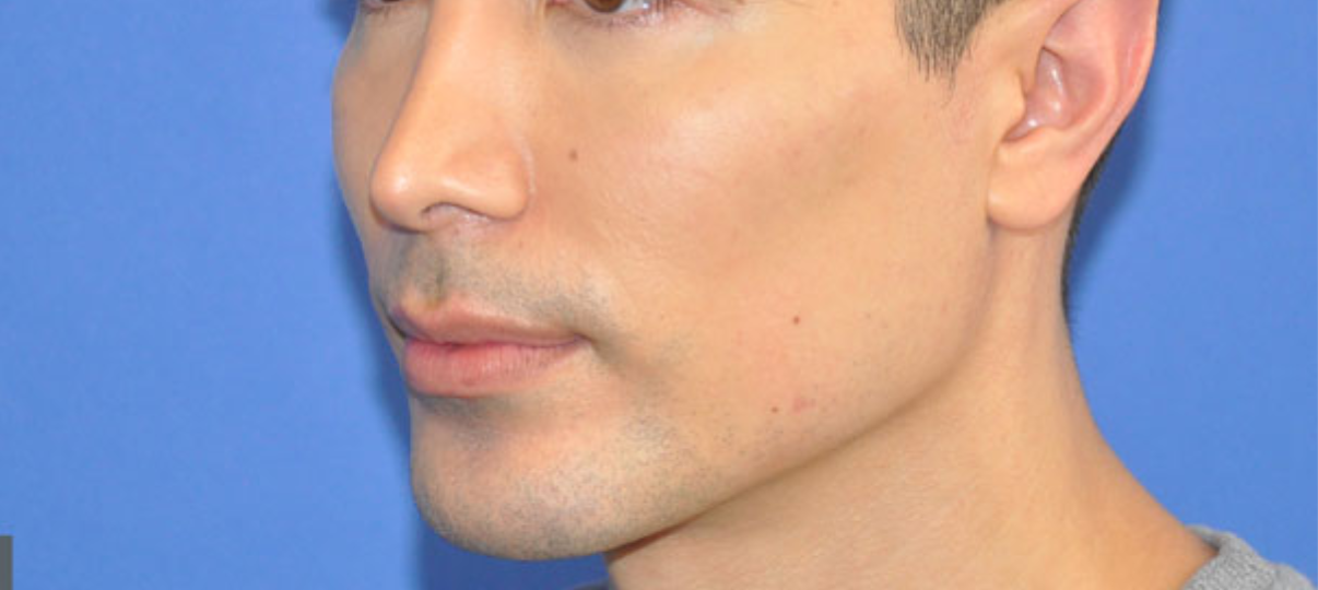 After Treatment