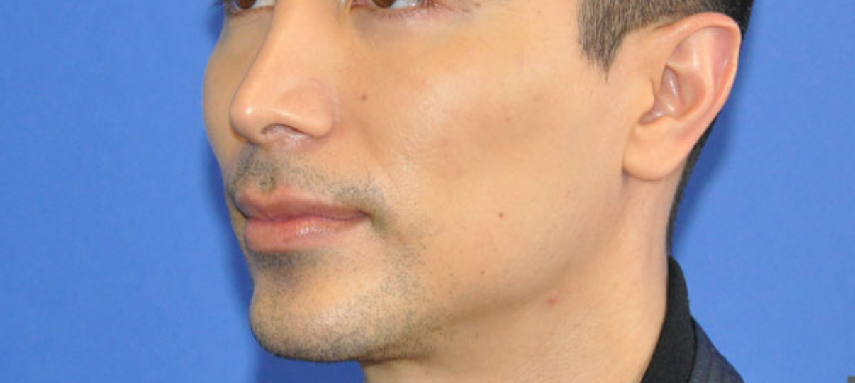 Before Treatment