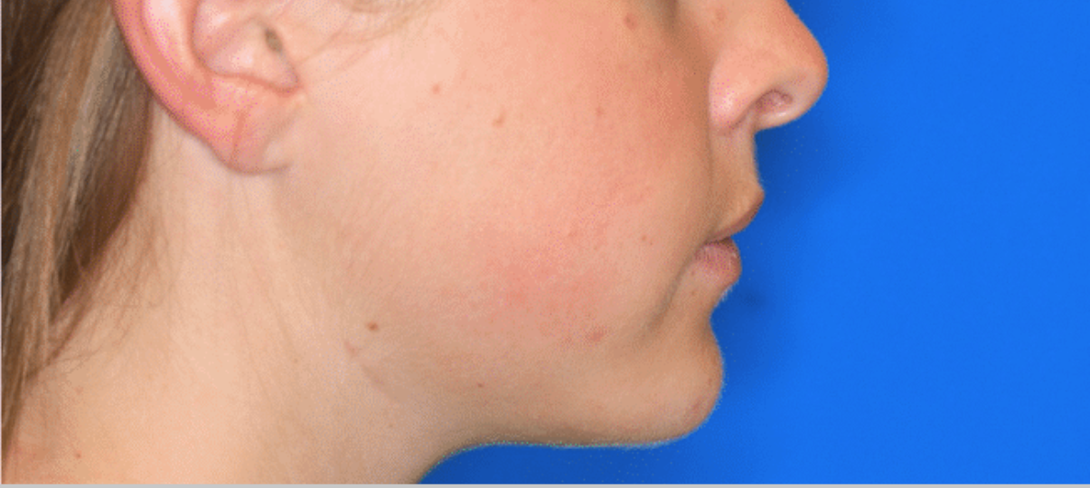 After Treatment