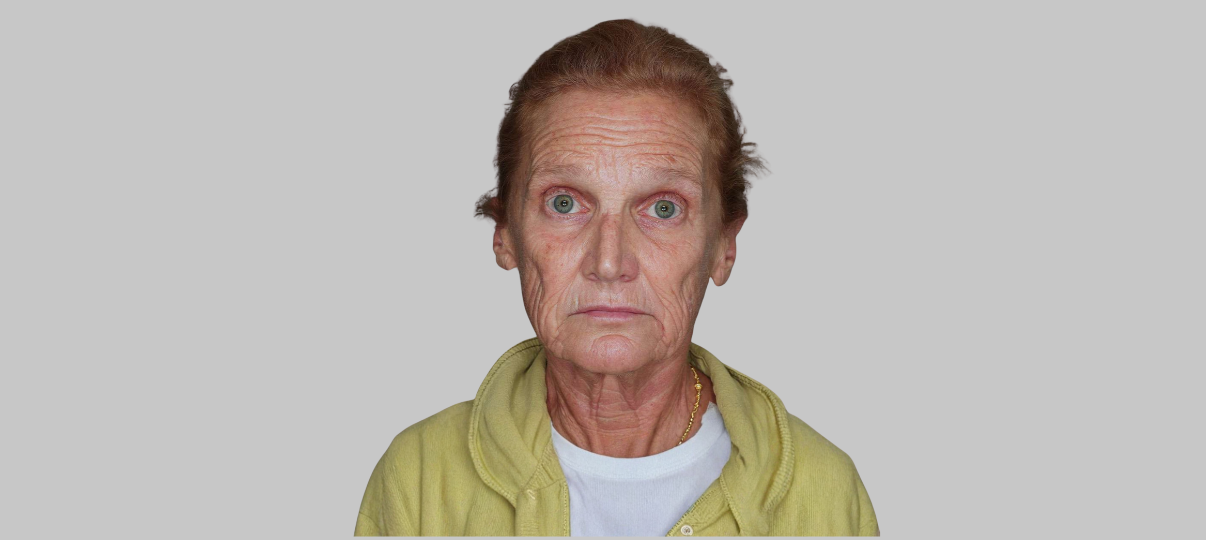 Before Treatment