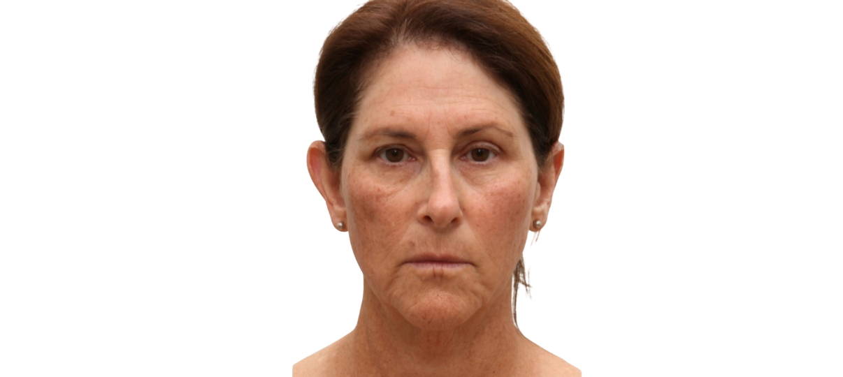 Before Treatment