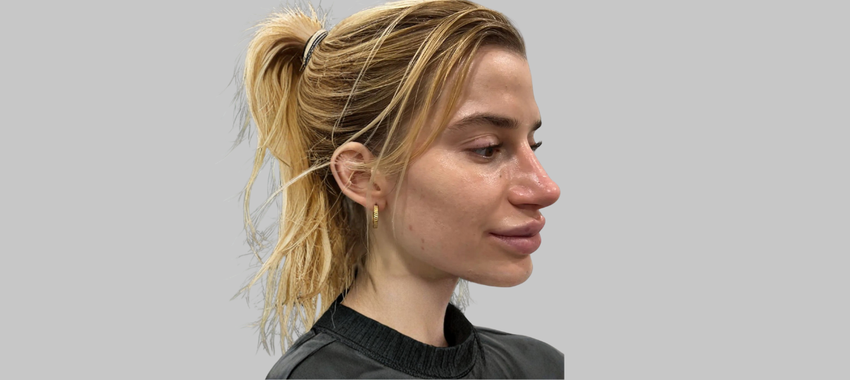 Before Treatment