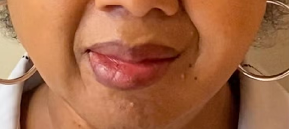 After Treatment