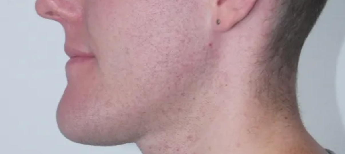 After Treatment