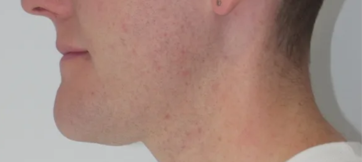 Before Treatment