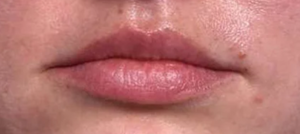 After Treatment