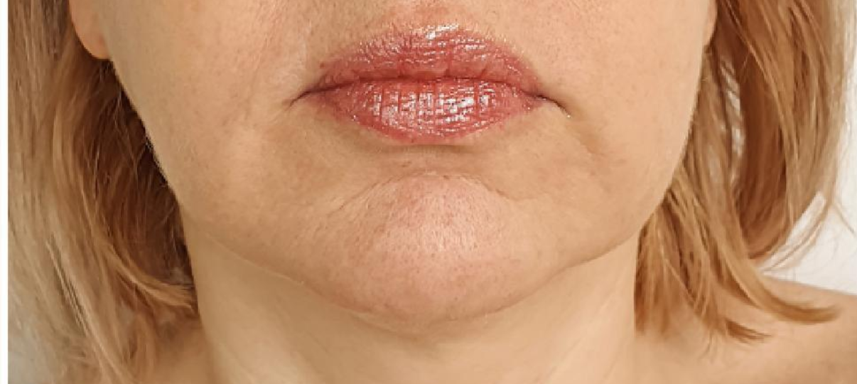 Before Treatment