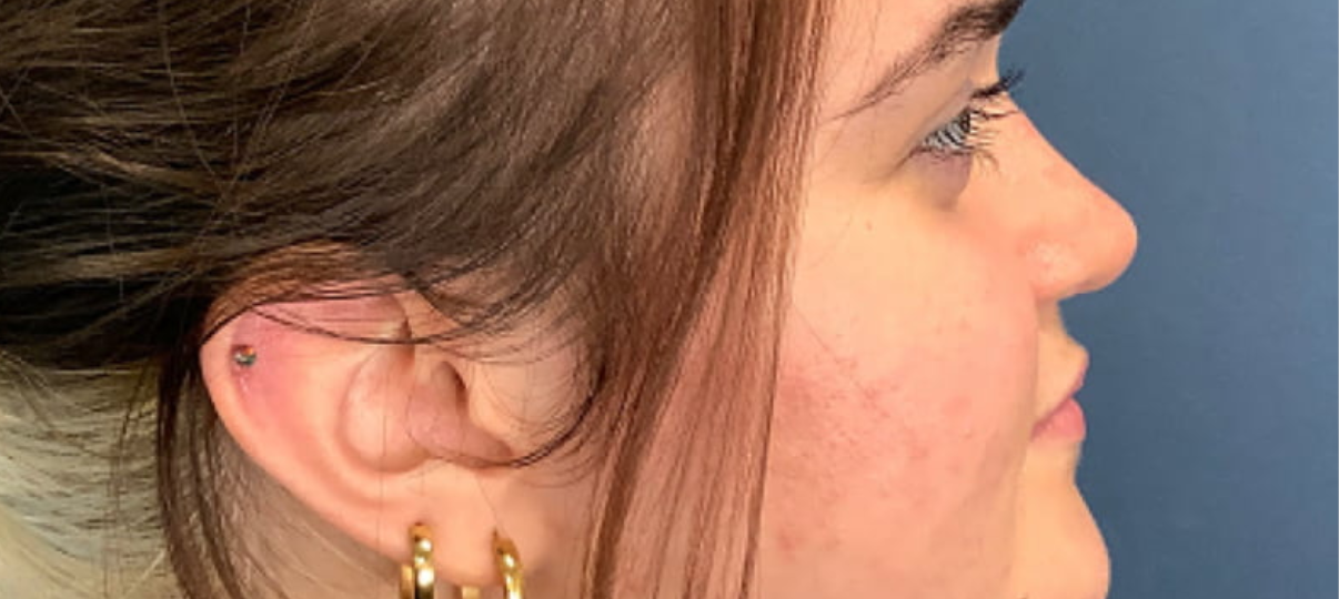 After Treatment