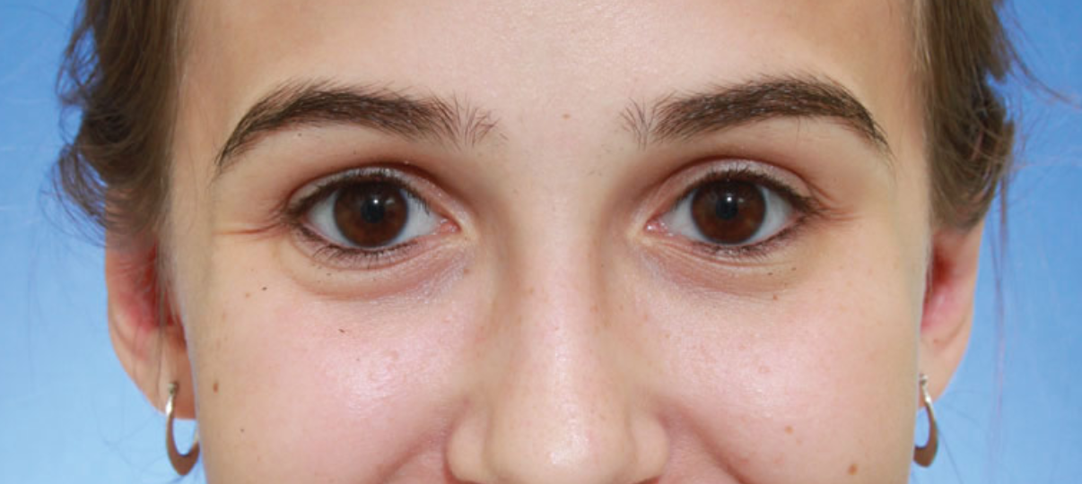After Treatment