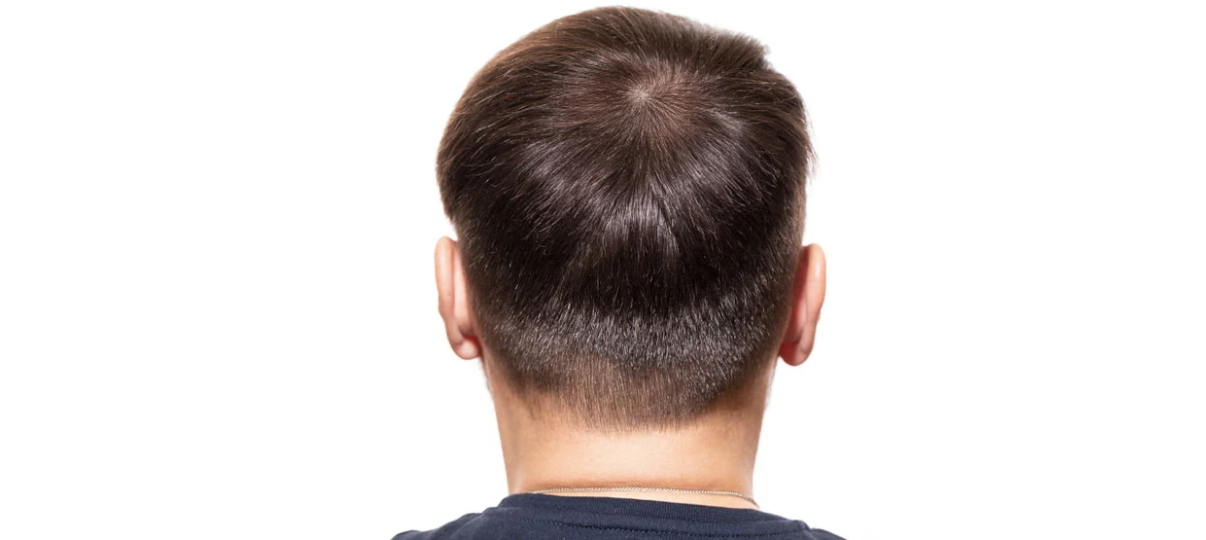 Before Treatment