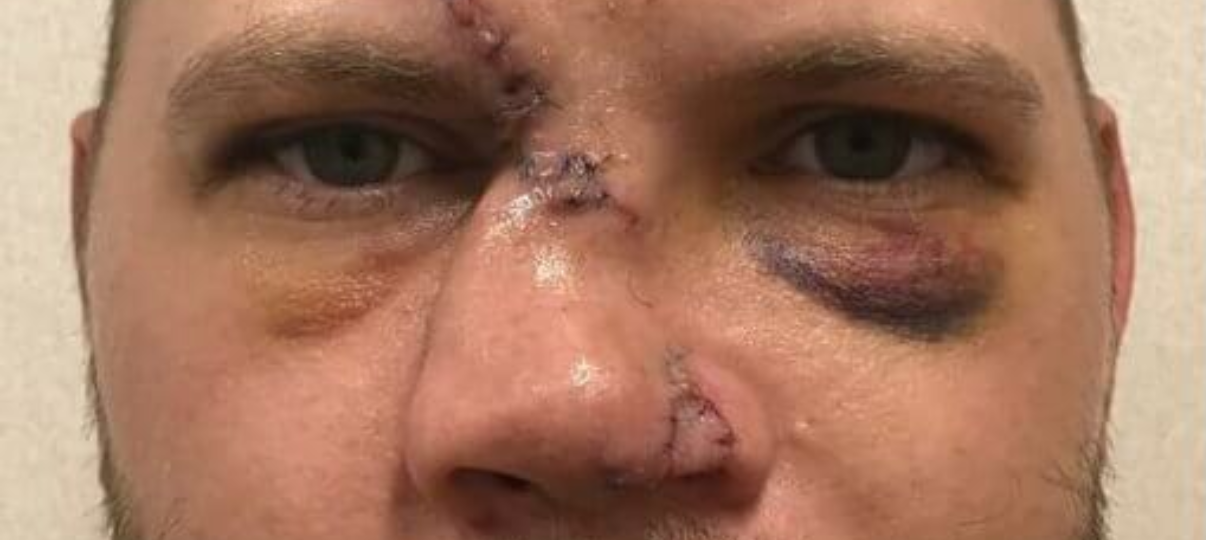 Before Treatment