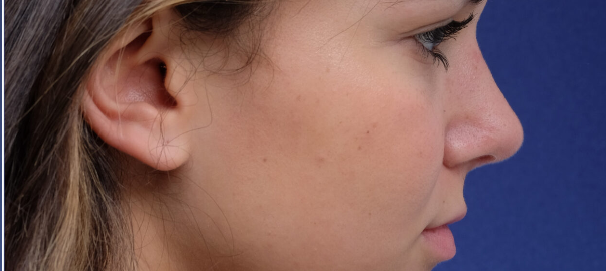 After Treatment