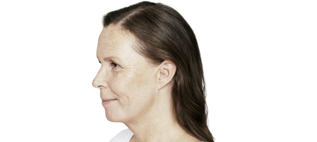 Before Treatment