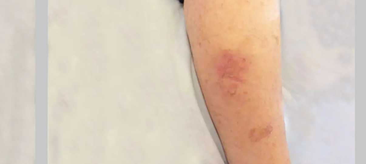 After Treatment