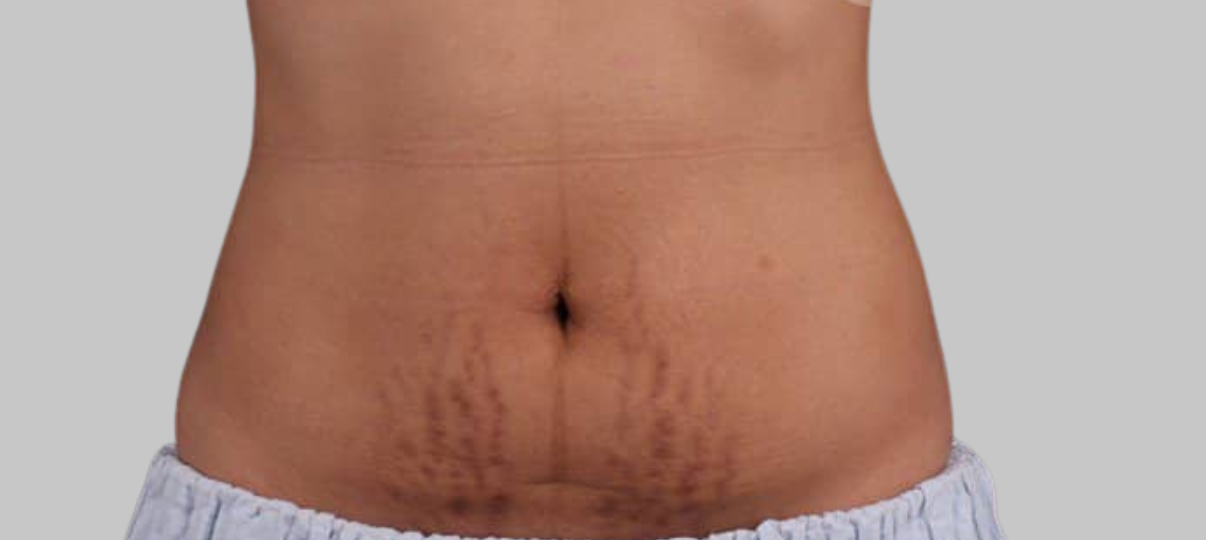 Before Treatment