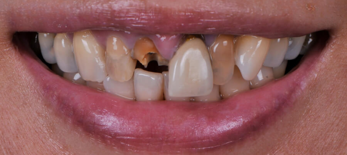 Before Treatment