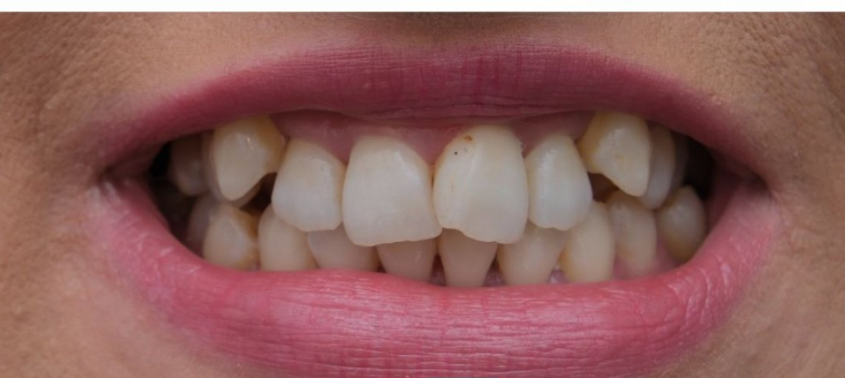 Before Treatment
