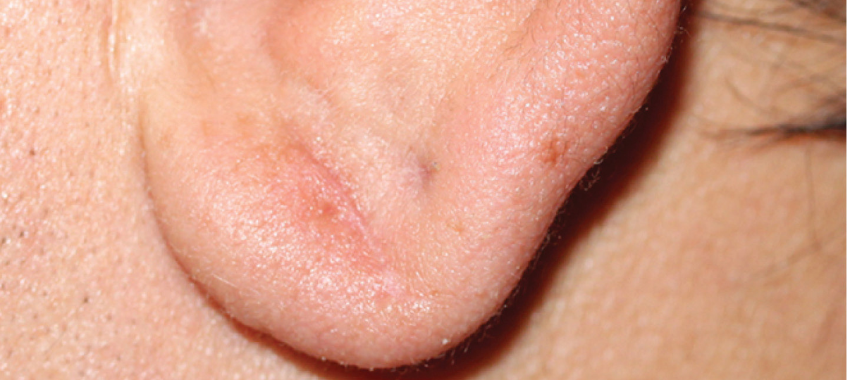 After Treatment
