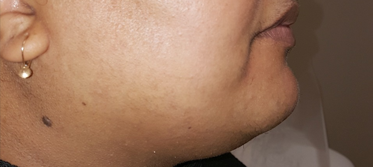 After Treatment