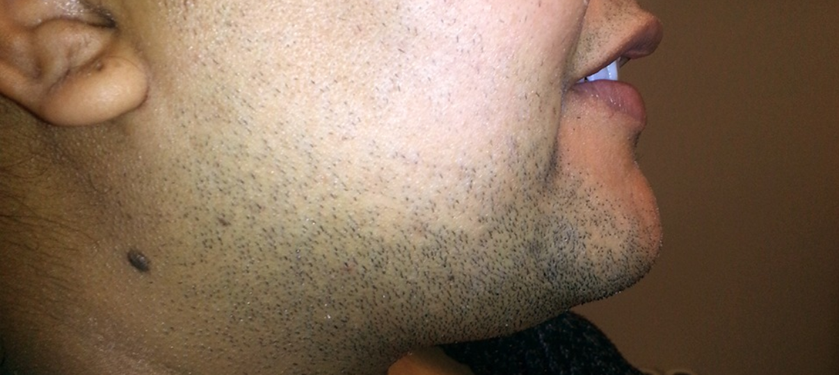 Before Treatment