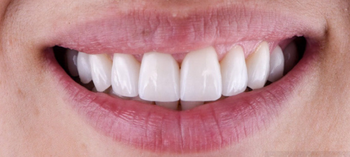 After Treatment