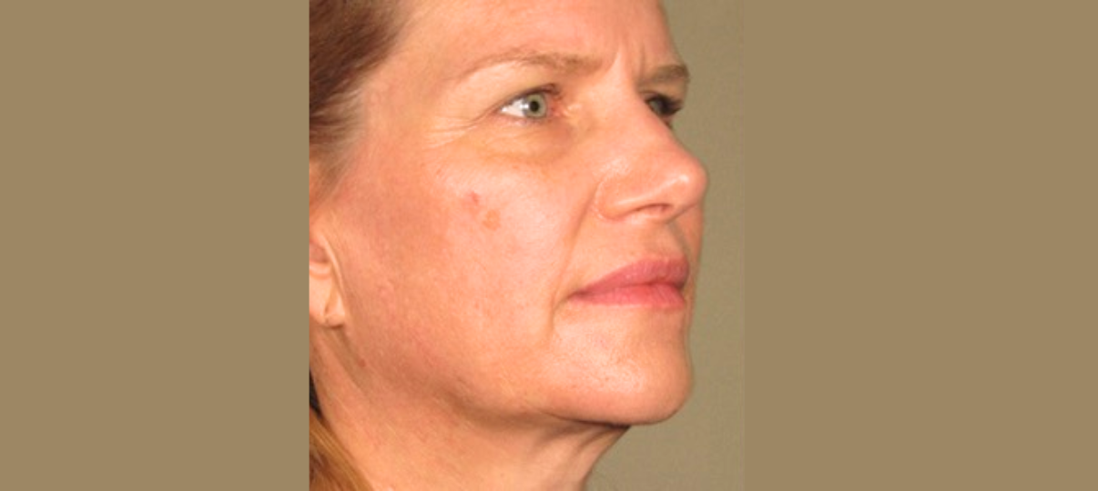 After Treatment