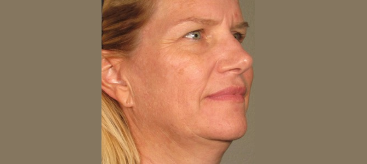 Before Treatment