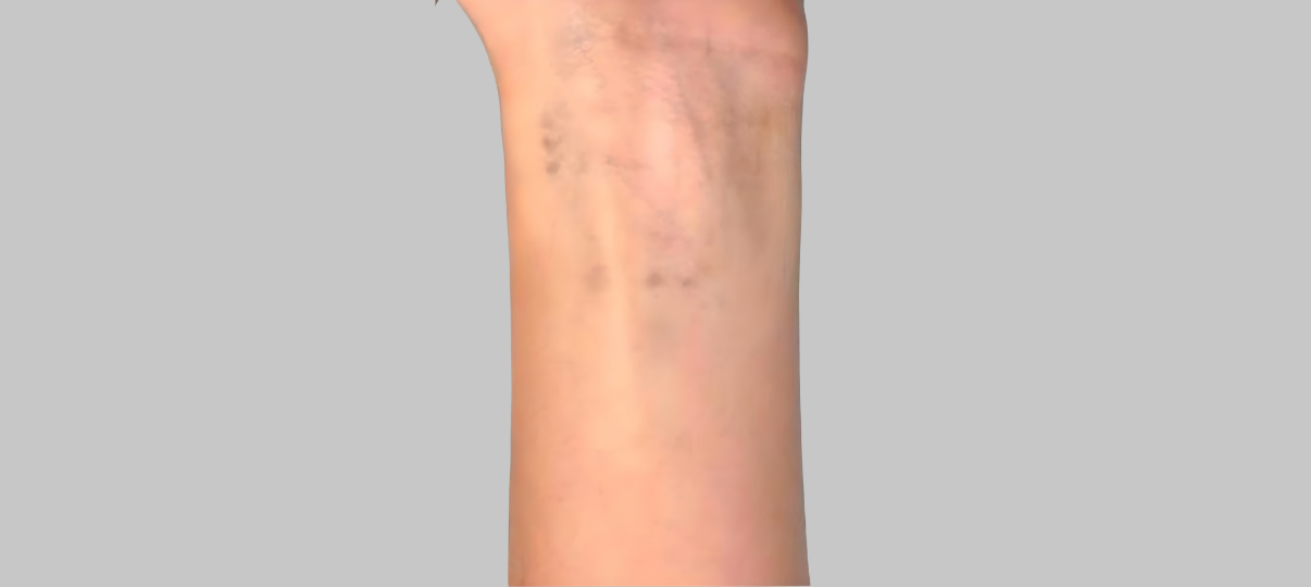 After Treatment